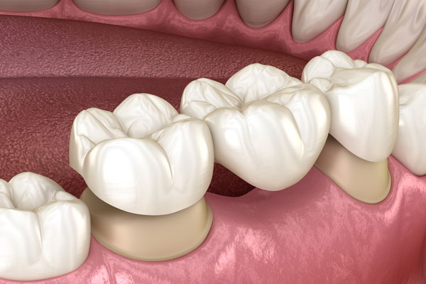 Puentes fijos y removibles