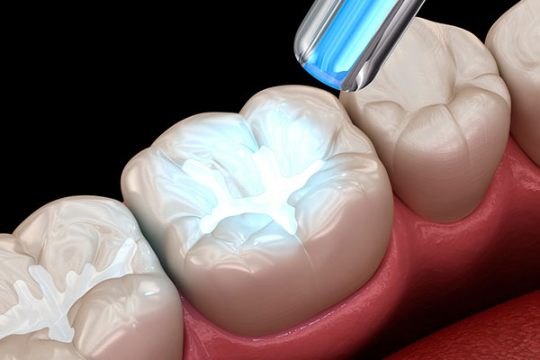 Restauraciones en resina